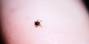 Nahaufnahme einer Zecke auf menschlicher Haut