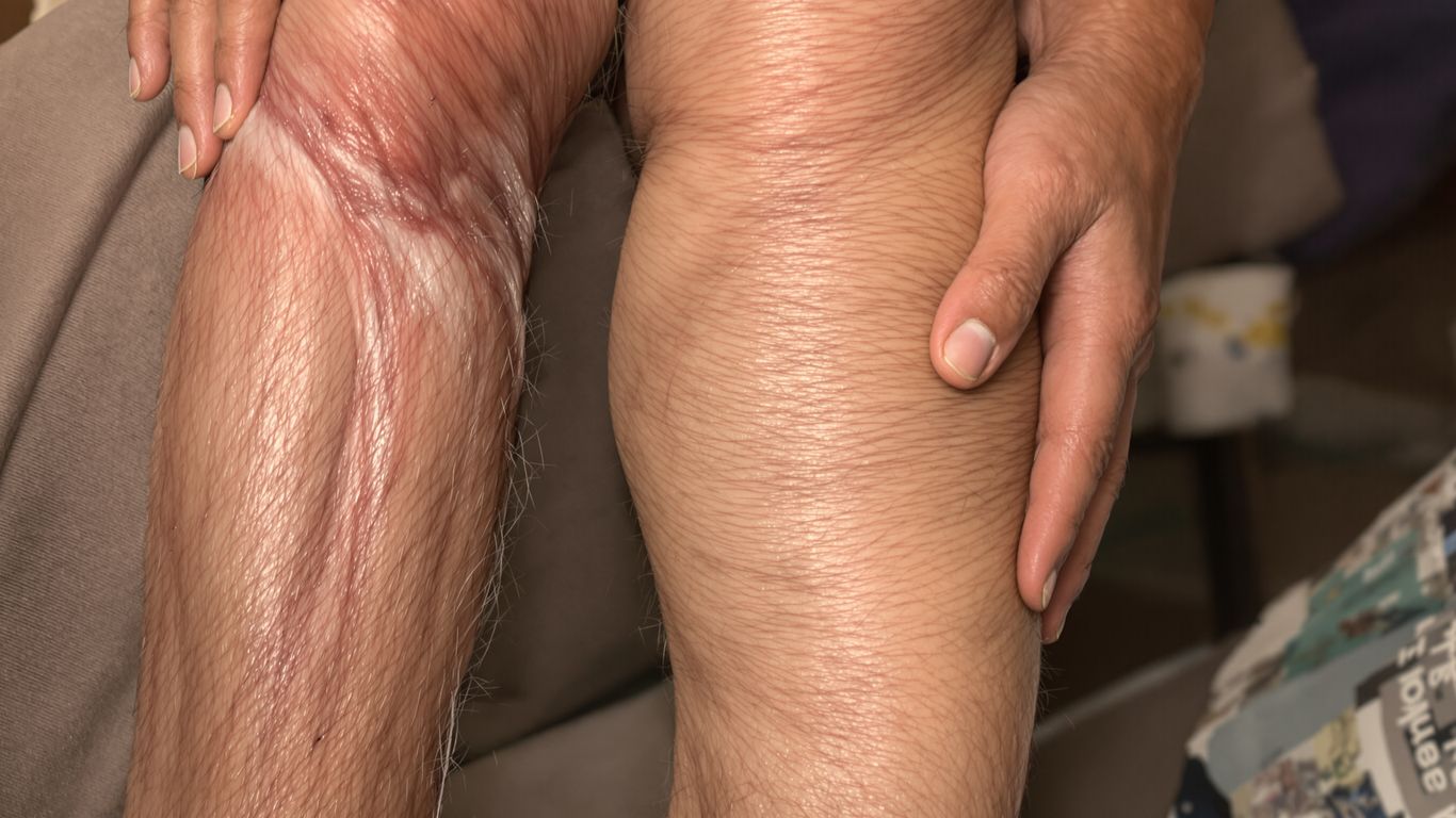 Person mit Wadenkrampf